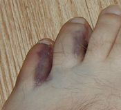 Close-up of damaged toes.